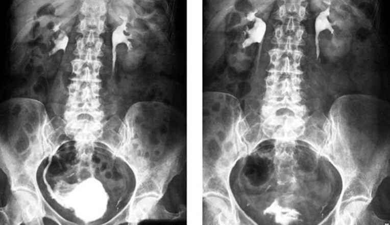 urograafia prostatiidi diagnoosimiseks